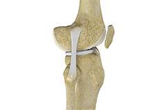Physical Therapy in Irvine, Newport Beach for Knee - Collateral Ligament  Injury